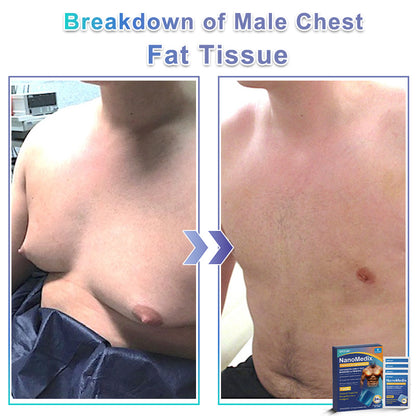 GFOUK® NanoMedix Gynecomastia Chest Fatburn & Firm Patch